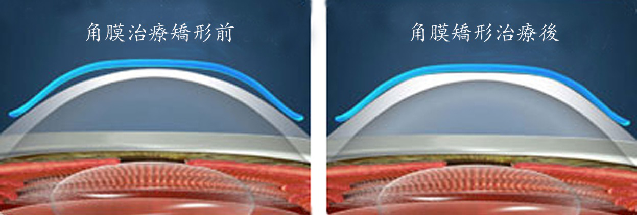 近視,OK鏡,角膜塑形鏡,度數(shù)增長(zhǎng),兒童近視 近視,OK鏡,角膜塑形鏡,度數(shù)增長(zhǎng),兒童近視