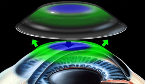 近視,OK鏡,角膜塑形鏡,度數(shù)增長,兒童近視 近視,OK鏡,角膜塑形鏡,度數(shù)增長,兒童近視